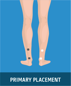 Using TENS for Diabetic Neuropathy, pad placement 